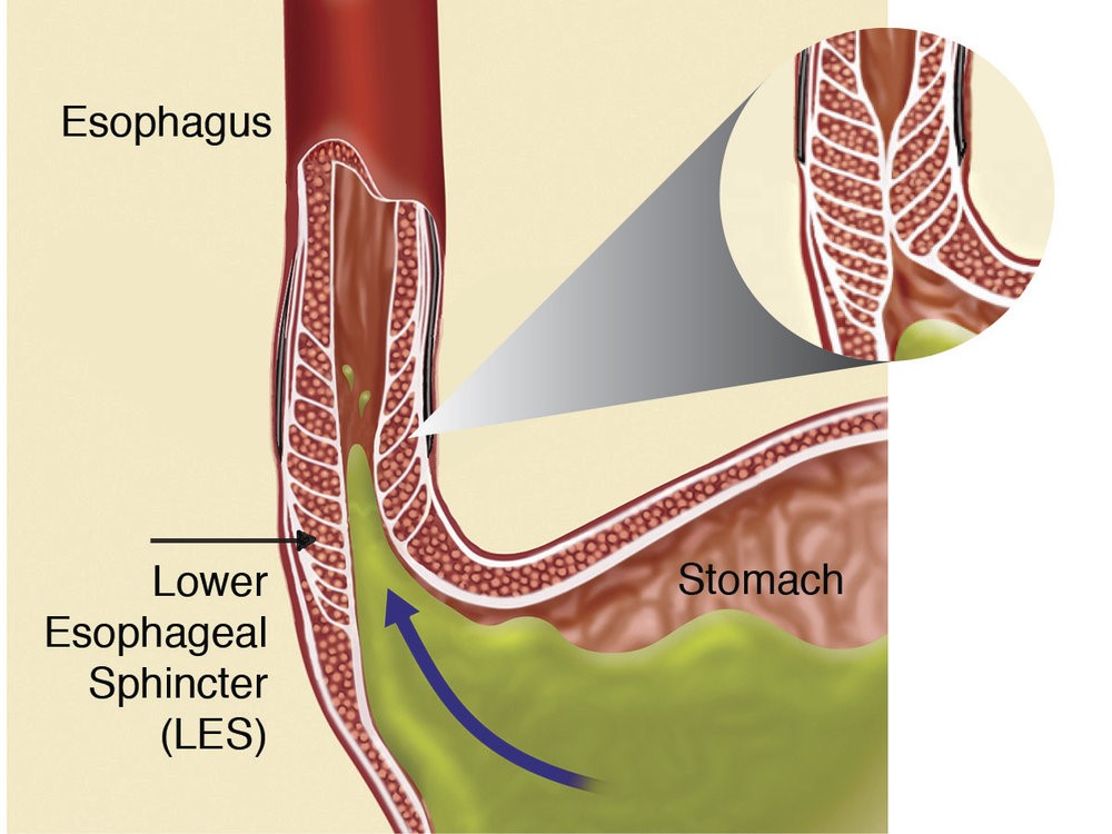Gastroesophageal reflux disease also known as
